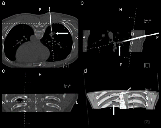 Técnica De Reconstrucción Multiplanar Para Biopsia Pulmonar Guiada Por ...